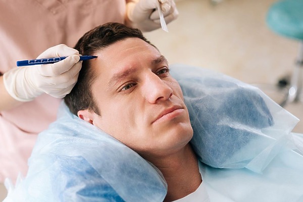 How Softer Hairlines Are Produced By Advanced Hair Transplant Techniques